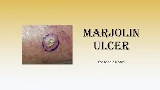 Marjolin ulcer - causes, risk factors, signs and symptoms, treatment, prognosis