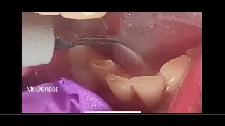Teeth Cleaning And Removal Of Calculus !!!!!!