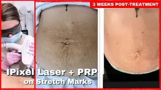 IPixel and PRP Treatment for Stretch Marks after Pregnancy | BEFORE AND AFTER