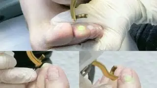 Laserbehandlung gegen Nagelpilz - NEU