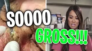 The GROSSEST & MOST DISGUSTING Moments from Dr. Pimple Popper!