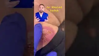 Infected abscess explained #skincare dr khaled sadek