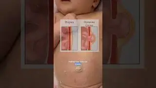 Пупкова грижа- що робити?  #діти #немовля #мамавдекрете