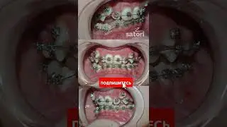 Фото перед брекетами  и после фиксации