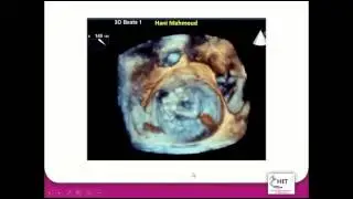 Mitral Para-Valvular leakage "3D-TEE Tips & tricks"