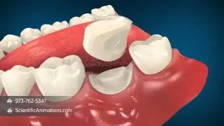 Crown Lengthening Animation | Dental Animation