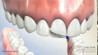 Diamond Strip for Interporximal Reduction - Orthodontic Treatment