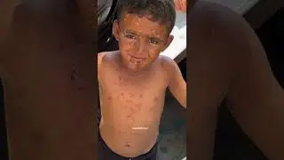 Les maladies de peau se répandent parmi les enfants palestiniens de la bande de Gaza