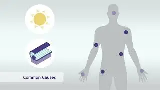 What is Skin Cancer? | SERO