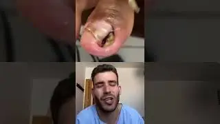 Ingrown toenail 