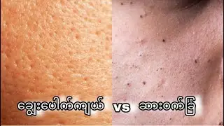 Large Pores and Blackhead Problems // ​ချွေး​ပေါက်ကျယ်နဲ့ ဆား၀က်ခြံပြသနာများ