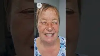 Пациентка жила без зубов 12 лет. Имплантация зубов.