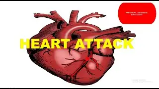 heart attack