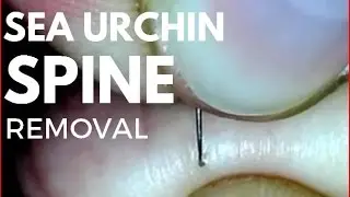 Sea urchin spine removal.