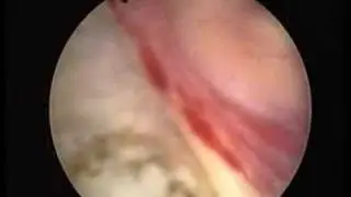 TURP