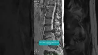Spinal disc herniation. When is conservative treatment not worth it? An MRI analysis of a patient...
