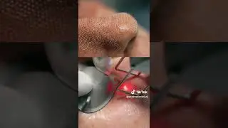 SATISFYING CO2 LASER RESURFACING & PRF  