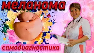 💊 Меланома 🔴 самостоятельно провести обследование. Симптомы и признаки меланомы. Вопросы доктору.