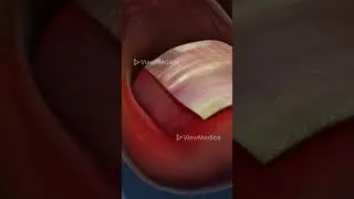 Ingrown Toenail Removal (3D Animation)