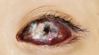 She Slept With Her Contacts In, This Is What Happened To Her Eyes