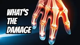 Is it Broken or Fractured?