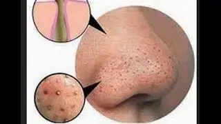DIY BLACKHEAD REMOVAL BANISHACNESCARS.COM