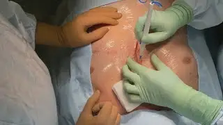 Chronic Partial Sternal Separation