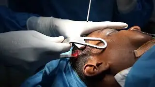 Riding without helmets? Head to Head Collision, Broken Face Corrected