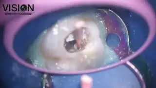 Obturation step for Maxillary 1st molar with MB2 under microscope with bioceramic sealer