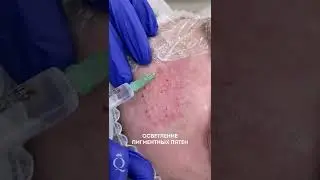 Лечение пигментации