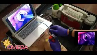 AirAngel Blade SALAD Suction Assisted Laryngoscopy and Airway Decontamination