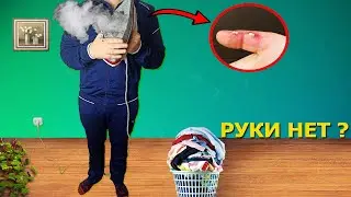 ПОЛУЧИЛ ОЖОГ ОТ РАСКАЛЕННОГО  УТЮГА. ПОСЛЕДСТВИЯ ОЖОГА