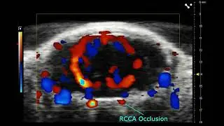 Vasculature in the Brain during Ischemic Stroke