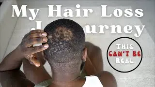 MY HAIR LOSS TO REGROWTH JOURNEY: Alopecia Areata, Treatment Process & More #mentalhealth #hairloss