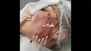 #мезонити