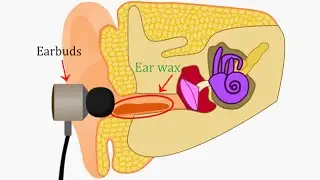 Putting  Earbuds In Your Ears Is VERY Bad And Here's Why