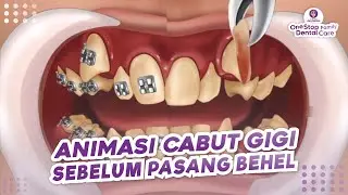 ANIMASI ASMR CABUT GIGI SEBELUM PASANG BEHEL