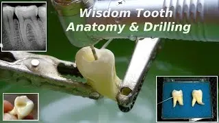 Third Molar (Wisdom Tooth) Anatomy & Drilling