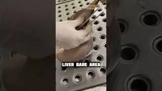 Coronary ligament and Liver bare area || #shorts #mbbs #viral #neet #short #shortfeed