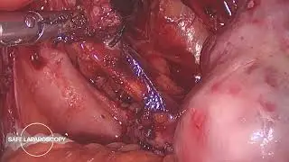 Adenomyosis and DIE resection: Technique