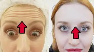BOTOX?! NÃO COMETA A MESMA BURRICE QUE EU!