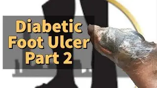 Diabetic Foot Ulcer - Part 2: Advanced Wound Care with Negative Pressure Wound Therapy