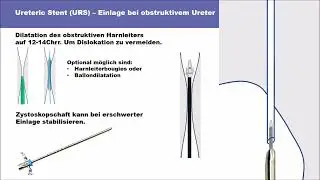 Allium URS Implantation