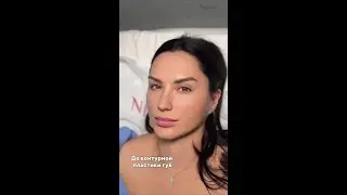 ПРЕОБРАЖЕНИЕ ПОСЛЕ КОНТУРНОЙ ПЛАСТИКИ ГУБ 🔥