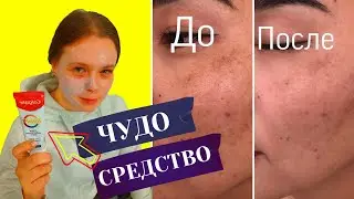Зубная паста Colgate И ЛИМОН легко очистят кожу лица от прыщей и черных точек | Лимон и колгейт