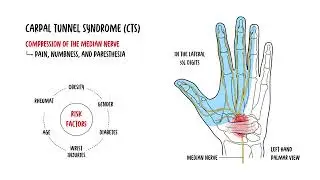 Understanding Carpal Tunnel Syndrome and Carpal Tunnel Anatomy