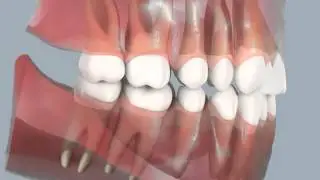 E Space with Braces (Faded) - Lateral View