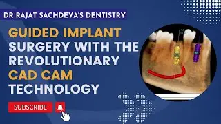 Guided Implant surgery  | Digital guided implant surgery | Benefits of 3D Guides | Delhi Dentist