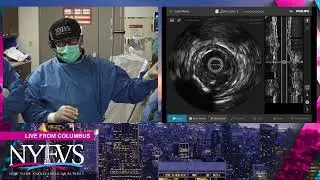 LIVE CASE PRESENTATION #3   SEVERE CALCIFIED LONG SUPERFICIAL FEMORAL ARTERY CTO   Broadcast From  O