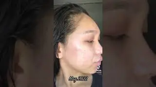 My Acne Journey #acnetreatment #acnejourney #skincare #skincareroutine #howtotreatacne